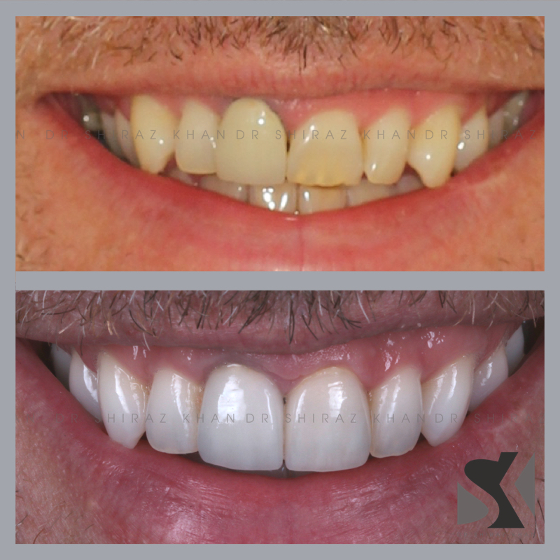 crowns and veneers