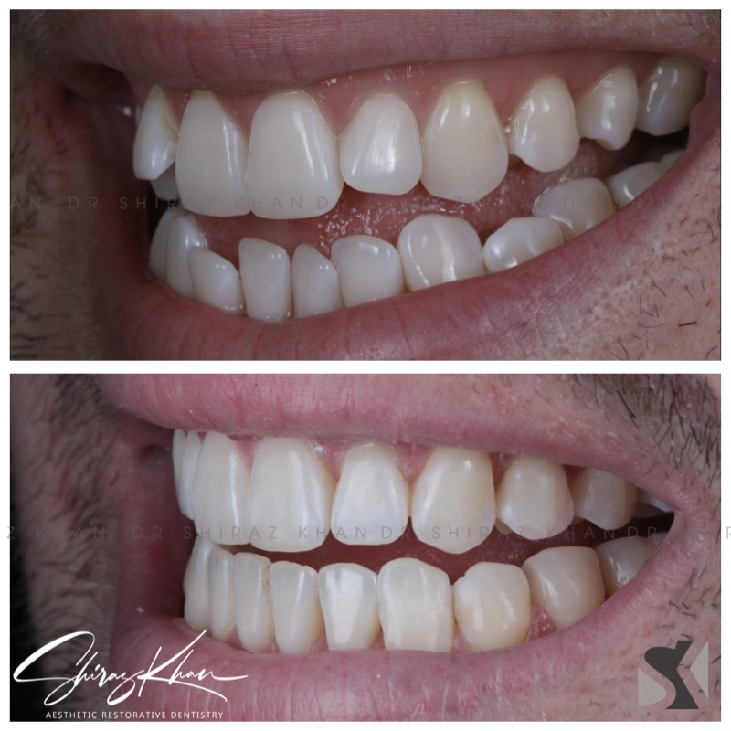 Clear aligners / Invisalign