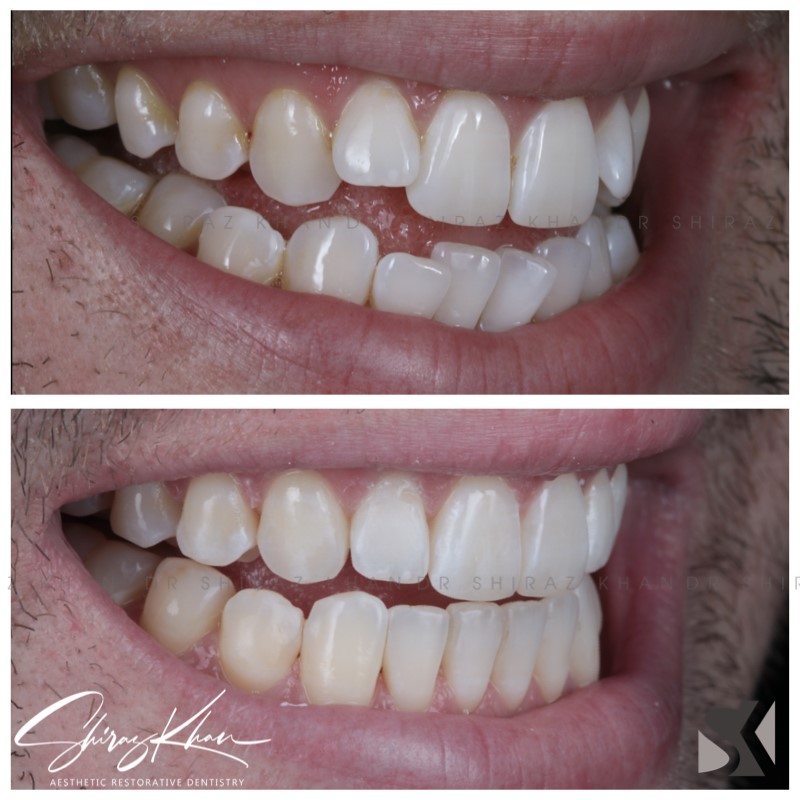 Clear aligners / Invisalign