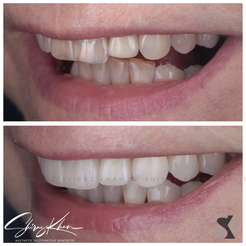Smile Design