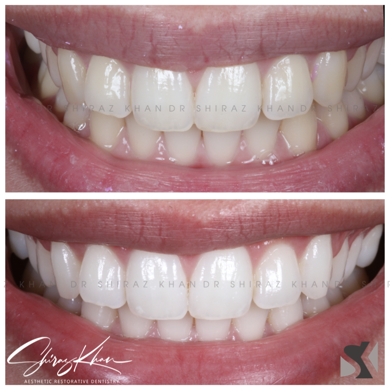 Whitening